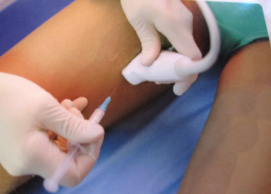 behandling åderbråck behandling åderbråck